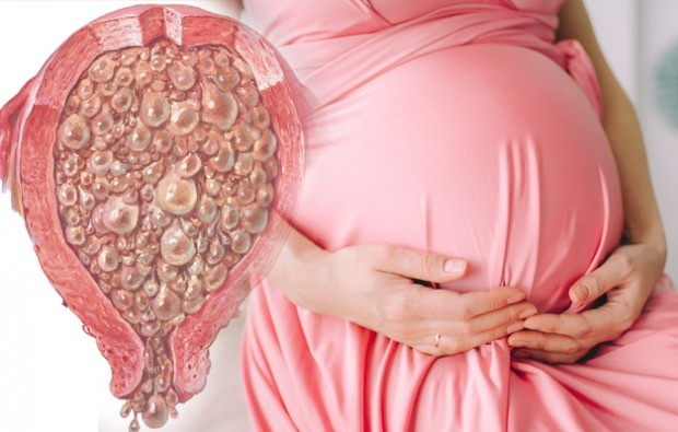 Какво е гроздова бременност, симптоми на гроздова бременност