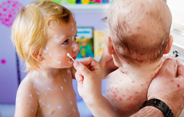 Симптоми на варицела в детска и детска възраст