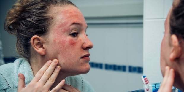 те се появяват върху кожата на човек със студена алергия