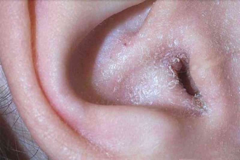 Какво причинява пилинг зад ухото и как преминава? Окончателното решение за екзема зад ушите ...