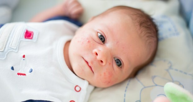 Как преминават акне по лицето на бебето? Методи за изсушаване на акне (Milia)
