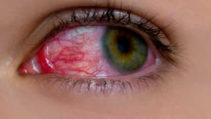 Какво причинява очна алергия? Какви са симптомите на очна алергия? Какво е добро за очните алергии? 
