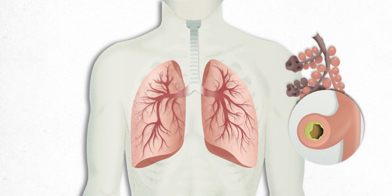 вирусът, който се настанява в белите дробове, се смесва с пневмония