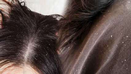 Как преминава пърхотът и какво е добро за косата с пърхот? 5 най-бързи и ефективни методи за премахване на пърхот