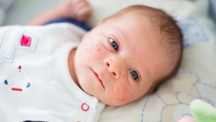 Как преминават акне по лицето на бебето? Методи за изсушаване на акне (Milia)