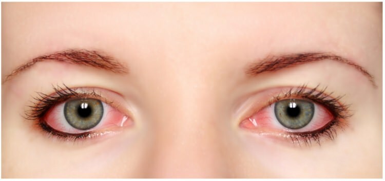 Има ли алергия към маскара и очна линия в очите?