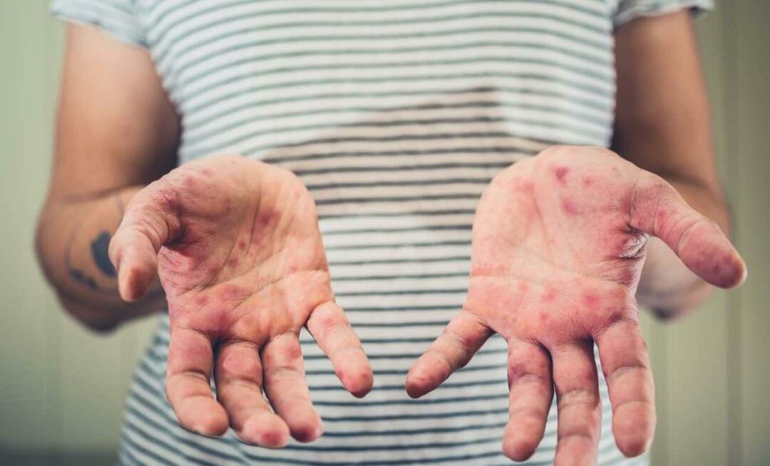 Каква е болестта на сина на Бурчу Кара? Какви са симптомите на болестта на ръцете, краката и устата? 