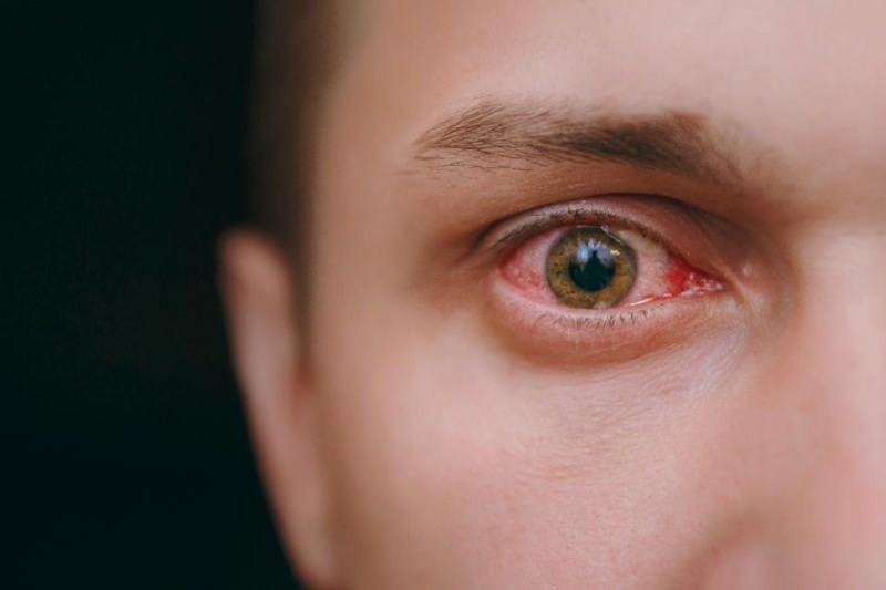 симптоми на поливане на очите, кървене и сърбеж на коронавирус