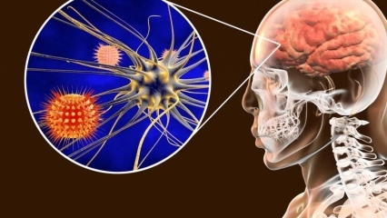 Какво е менингит и какви са симптомите? Има ли лечение за менингит?