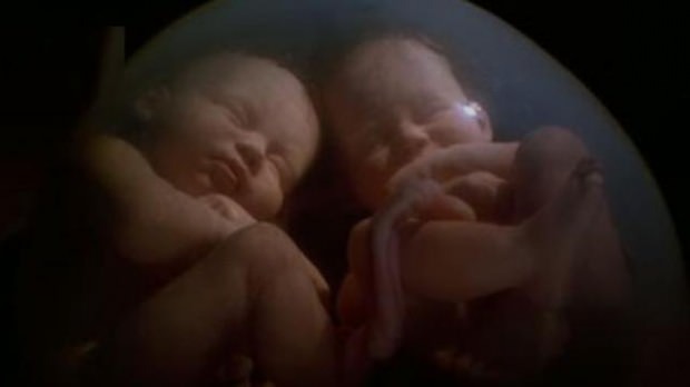 Какво е синдром на преливане на близнак в близнак?