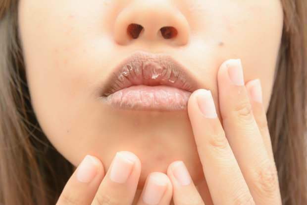 анемия причинява сухи устни