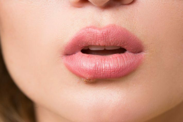 Какво е рак на езика? Какви са симптомите?