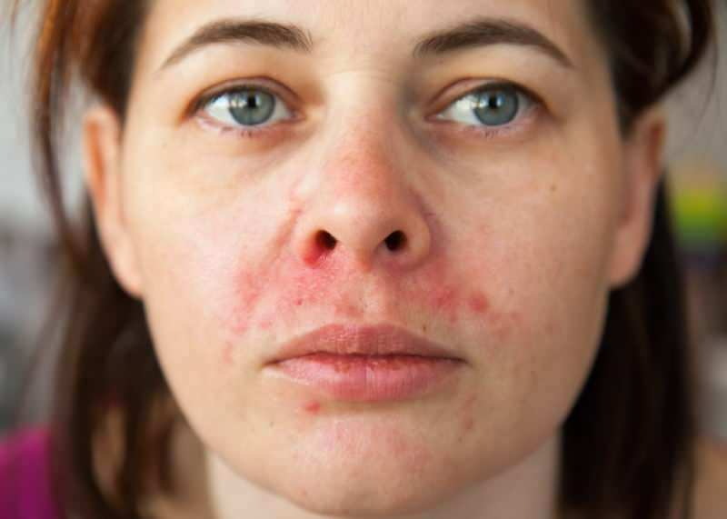 Защо акнето се появява около устната? Как се лекува периорален дерматит?