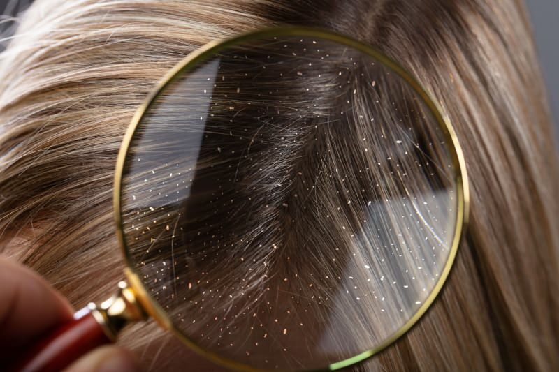 Как преминава пърхотът и какво е добро за косата с пърхот? 5-те най-бързи и ефективни средства за пърхот