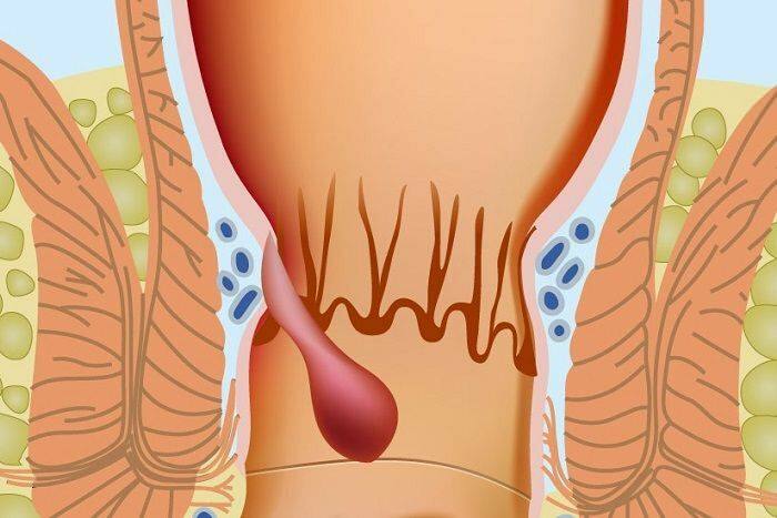 Как се появяват хемороидите в аналната част 