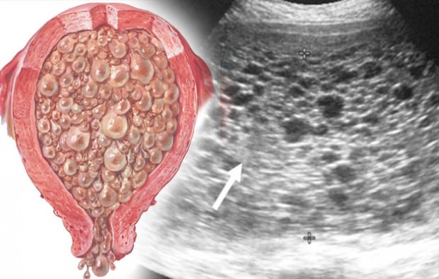 Какво представляват симптомите на бременността с гроздова бременност?
