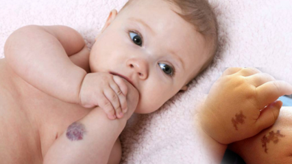 Причинява родилен белег при бебета, постоянен ли е? Какви са видовете родилни петна? Лек от Саракоглу