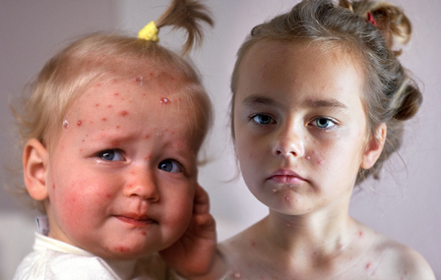 Как да разберем варицела в детска и детска възраст? Симптоми на варицела и лечение
