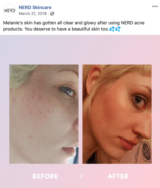 Пример за това как Nerd Skincare използва снимка преди и след това, за да създаде публикация на изображение за социални медии, която стимулира покупките на техните продукти.