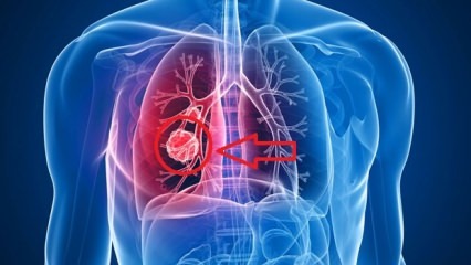 Симптоми на рак на белия дроб: стадии на рак на белия дроб!