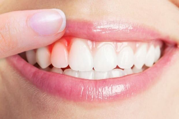 Какво причинява кървене на венците?