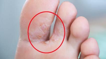 Какво е гъбички на краката? Какви са симптомите на стъпалото на спортиста? Лечение на стъпало на спортиста 
