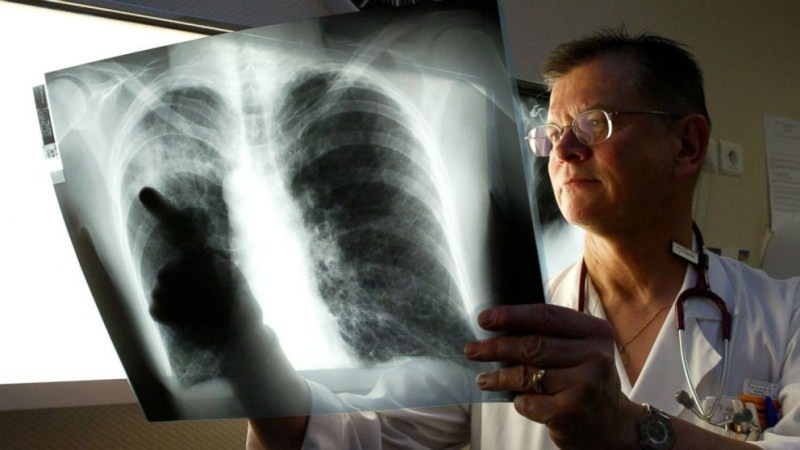 легионерен вирус се установява в белите дробове 