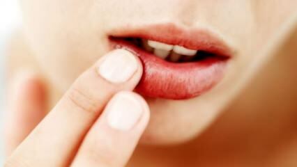 Какво е добро за напукване на устните?