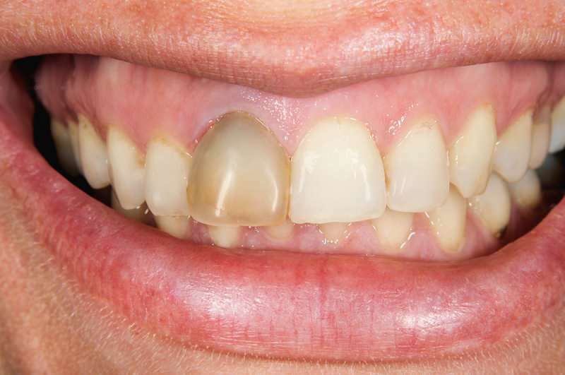 потъмняването на зъбите понякога може да се концентрира върху един зъб
