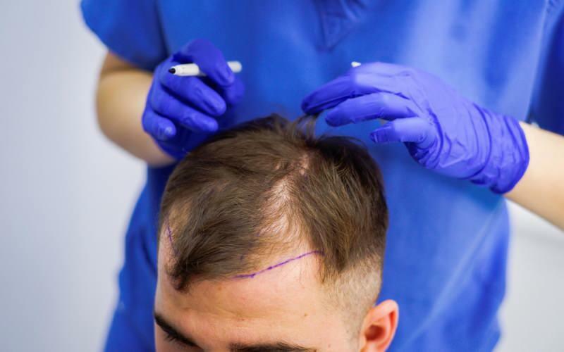 Допустимо ли е да се трансплантира коса при лечение на косопад? Какво представлява протезната коса? Протезира ли косата пречка на ghusl?