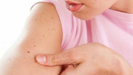 Какво представлява ракът на кожата (кожата) и какви са неговите симптоми? Начини за разбиране на рака на кожата