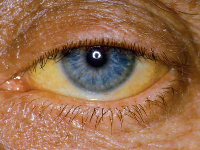 височината на ниво билирубин причинява жълт цвят на очите и кожата