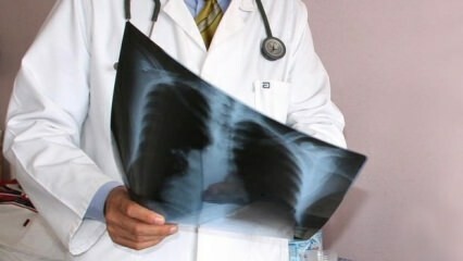 Обявиха експерти! Увеличаване на смъртните случаи от рак на белия дроб
