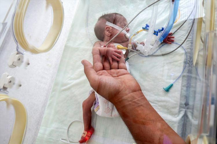 „Чудо бебе“ успя да преживее операцията