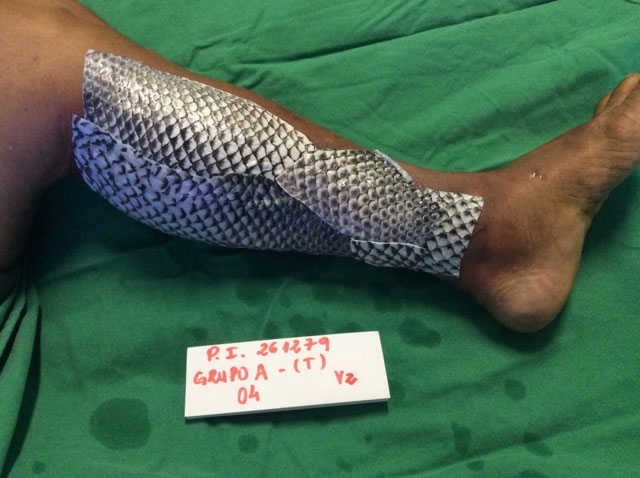 Кожата на рибата премина в медицинската история при лечението на изгаряния
