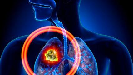 Какви са симптомите на рак на белия дроб? Има ли лечение за рак на белия дроб?