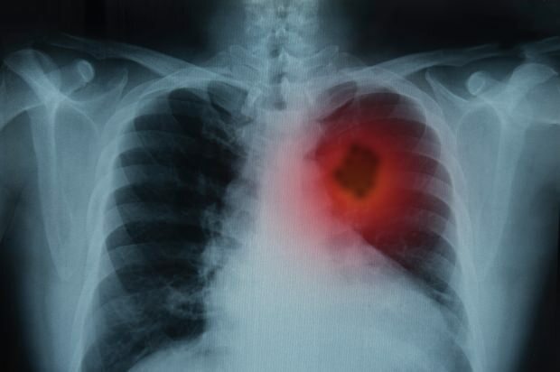 Какви са симптомите на рак на белия дроб? Има ли лечение на рак на белия дроб? За предотвратяване на рак на белия дроб ...