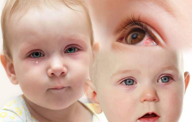причинява кървене от очите при бебета