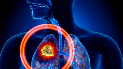 Какви са симптомите на рак на белия дроб? Има ли лечение на рак на белия дроб? За предотвратяване на рак на белия дроб ...