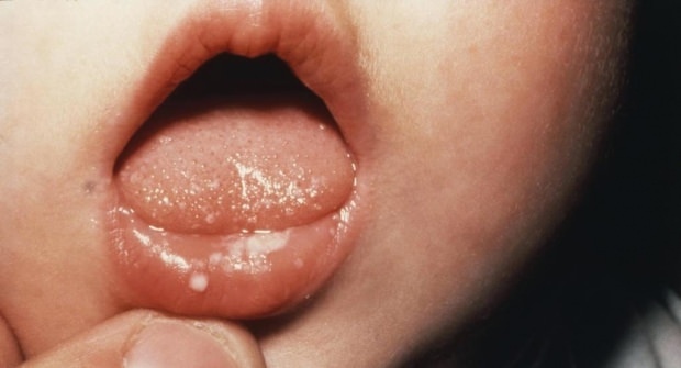 Как боли уста в бебетата