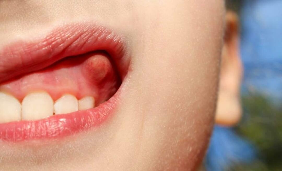 Защо зъбът абсцесира и какви са симптомите? Зъбен абсцес, как се лекува?