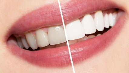 Какви са препоръките за белите зъби? Избелването на зъбите лекува естествено у дома ...