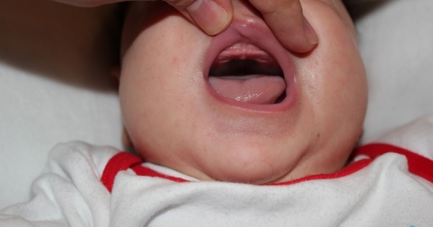 Какво представлява спадът на небцето при бебетата, защо? Симптоми и лечение ...
