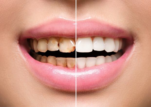 В резултат на нездравословното хранене възниква както обезцветяване на зъба, така и загуба на зъб