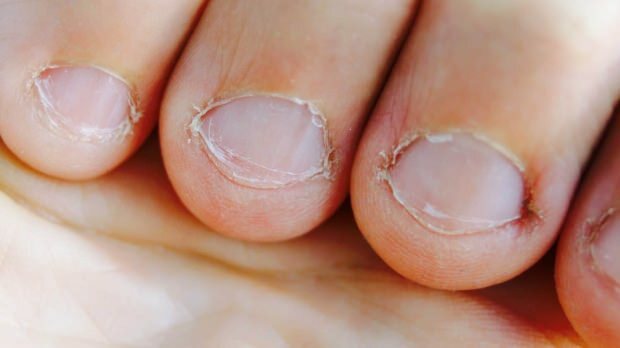Какво е заболяване при хранене на ноктите? Какви заболявания причинява храненето на ноктите?
