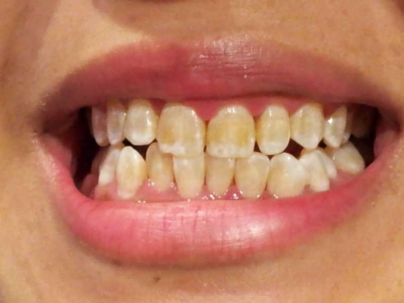 изображение на зъб на човек, чиито зъби започват да потъмняват