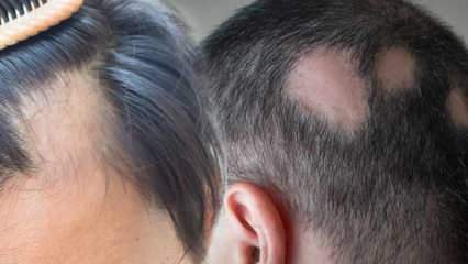 Какво е трихофития (Alopecia areata)? Какви са симптоми на трихофития? Ефективни решения при трихофития