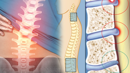 Какво е стесняване на гръбначния мозък? Какви са симптомите на стесняване на гръбначния мозък? Има ли лекарство за стесняване на гръбначния мозък?