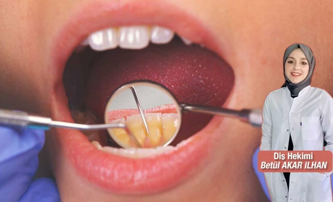 Какво трябва да се направи, за да се избегне появата на зъбен камък? Какви са ползите от почистването на зъбен камък?