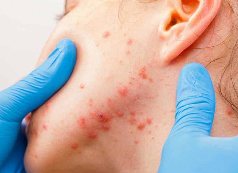 вирусът причинява мехури по повърхността на кожата